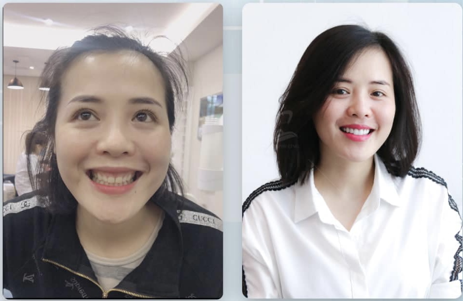 phương pháp chữa cười hở lợi không phẫu thuật