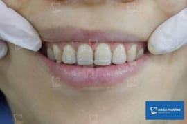 SAU CẮT LỢI NÊN KIÊNG GÌ VÀ ĂN GÌ?