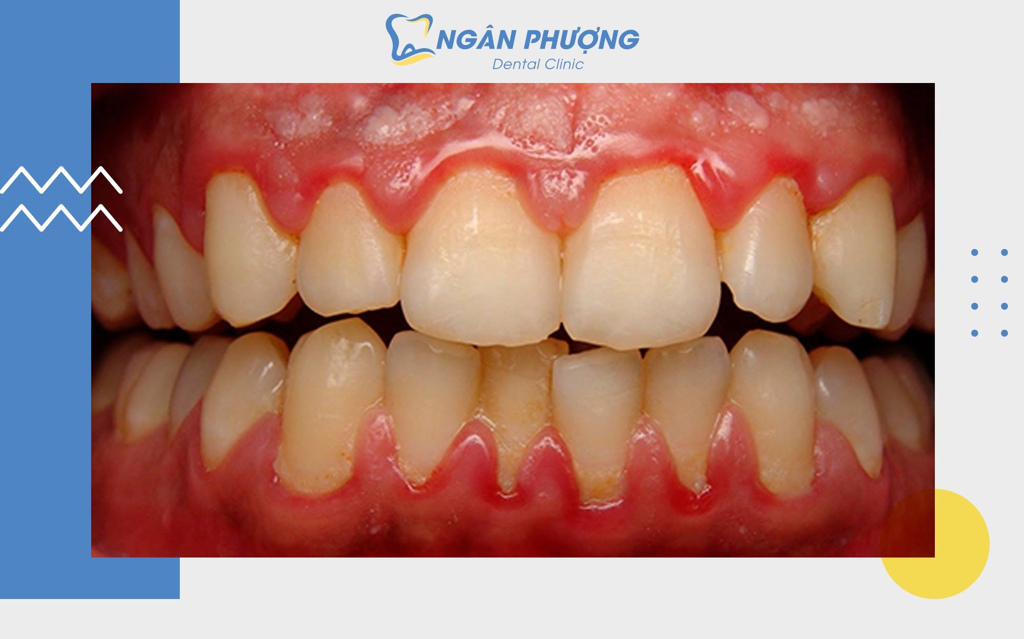 viêm nướu răng 2