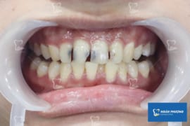 BỌC RĂNG SỨ CHO RĂNG SÂU – QUY TRÌNH, CHI PHÍ VÀ NHỮNG LƯU Ý KHI THỰC HIỆN