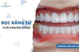 BỌC RĂNG SỨ CÓ TẨY TRẮNG ĐƯỢC KHÔNG?