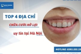 CHỮA CƯỜI HỞ LỢI Ở ĐÂU UY TÍN TẠI HÀ NỘI
