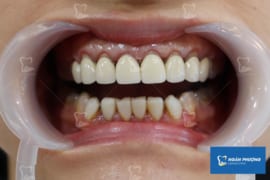 5 DẤU HIỆU RĂNG SỨ BỊ HỞ VÀ CÁCH KHẮC PHỤC TÌNH TRẠNG NÀY