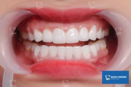 QUY TRÌNH BỌC RĂNG SỨ AN TOÀN VÀ HIỆU QUẢ