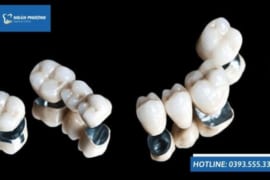 CÓ NÊN BỌC RĂNG SỨ KIM LOẠI HAY KHÔNG?