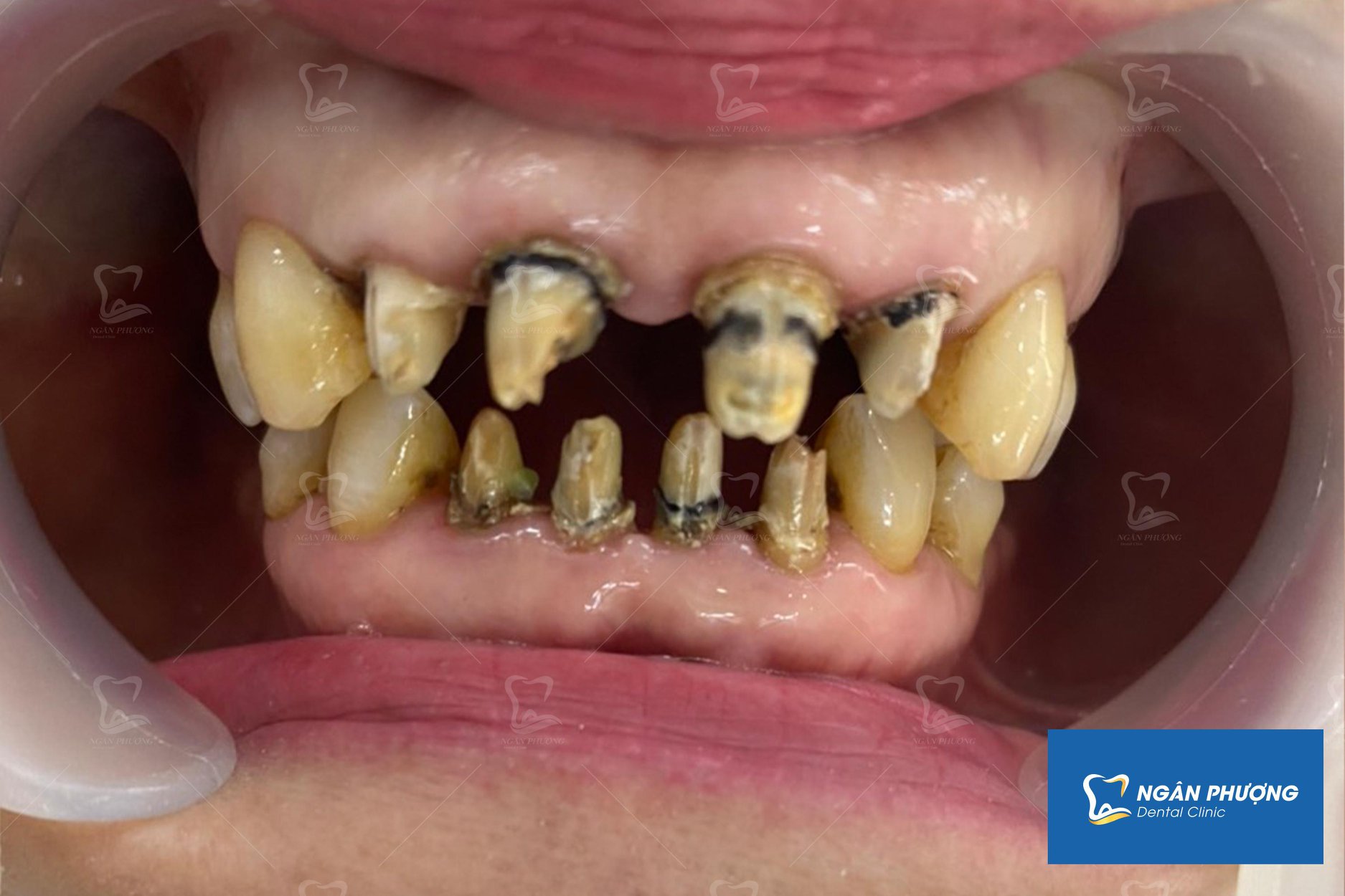 răng sứ kim loại có thể gây đen nướu