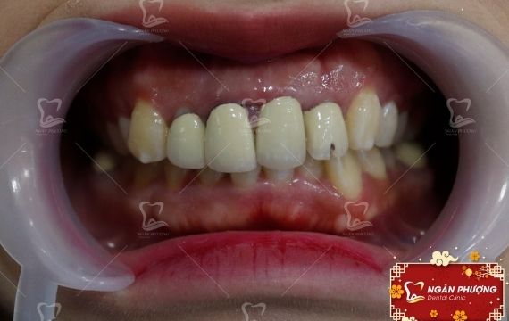 răng sứ kim loại để lâu sẽ bị đen viền nướu