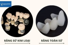 SO SÁNH RĂNG SỨ KIM LOẠI VÀ RĂNG TOÀN SỨ