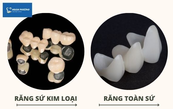 SO SÁNH RĂNG SỨ KIM LOẠI VÀ RĂNG TOÀN SỨ - Nha Khoa Ngân Phượng