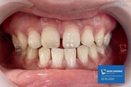 RĂNG THƯA NÊN NIỀNG HAY BỌC SỨ? GIẢI PHÁP NÀO CHUYÊN GIA KHUYÊN DÙNG