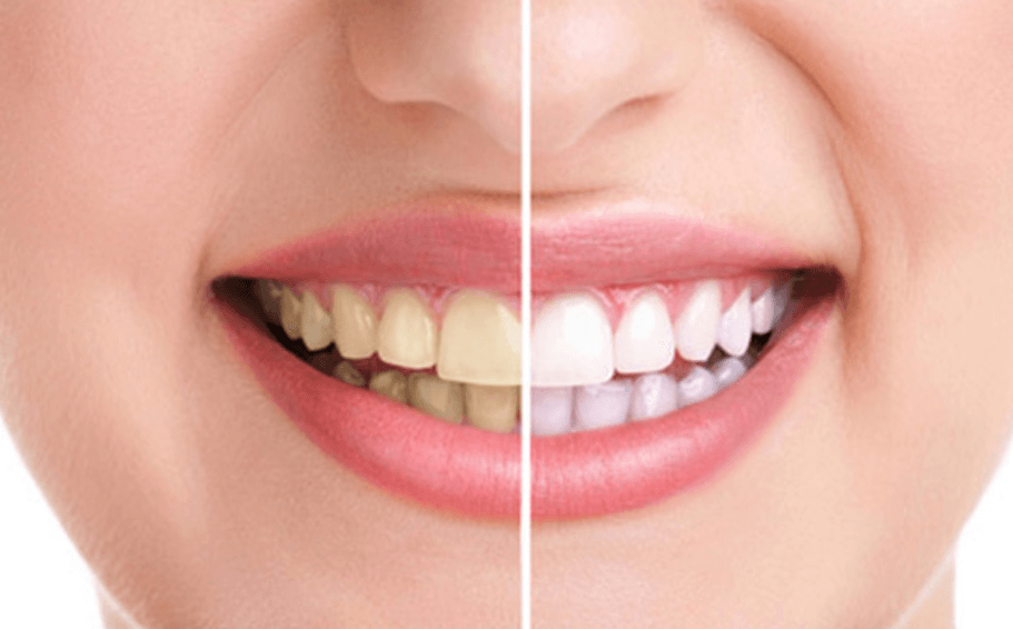 tẩy trắng răng sứ