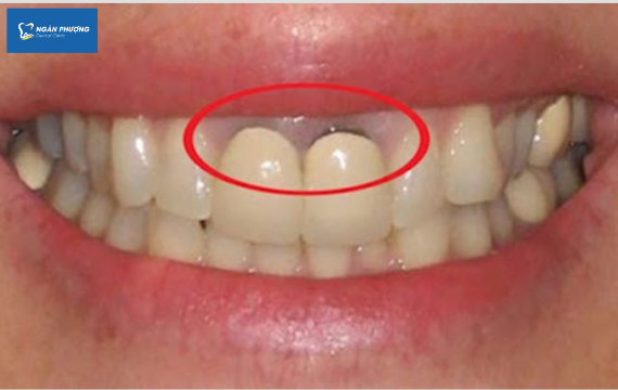 bọc răng sứ kém chất lượng