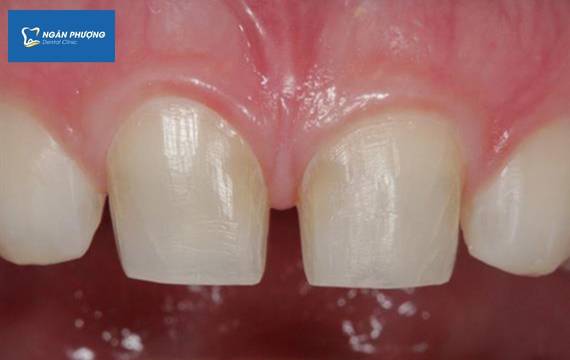 chất lượng cùi răng quyết định bọc răng sứ có bền không