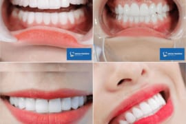 BÍ KÍP CHỌN MÀU RĂNG SỨ ĐẸP VÀ TỰ NHIÊN
