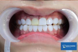 5 HẬU QUẢ BỌC RĂNG SỨ SAI CÁCH