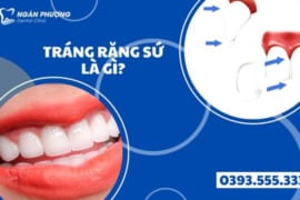 TRÁNG RĂNG SỨ BAO NHIÊU TIỀN? ƯU-NHƯỢC ĐIỂM CỦA PHƯƠNG PHÁP TRÁNG RĂNG SỨ