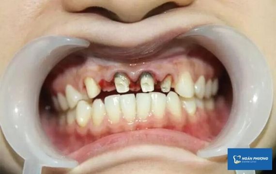viêm lợi sau khi bọc răng sứ