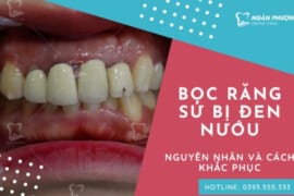 BỌC RĂNG SỨ BỊ ĐEN NƯỚU – NGUYÊN NHÂN VÀ CÁCH KHẮC PHỤC