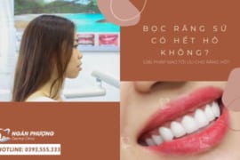 BỌC RĂNG SỨ CÓ HẾT HÔ KHÔNG? GIẢI PHÁP NÀO TỐI ƯU CHO RĂNG HÔ?