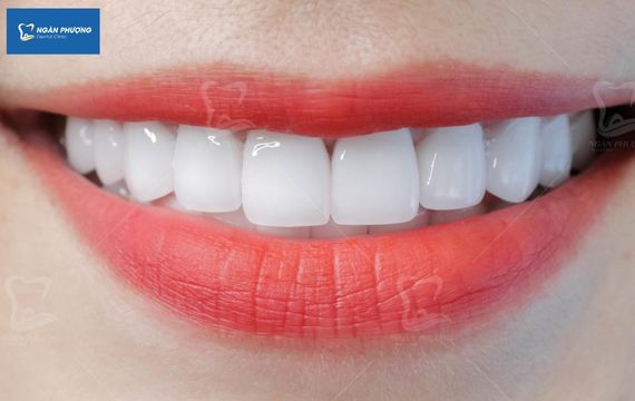 bọc sứ răng hàm nên sử dụng loại nào