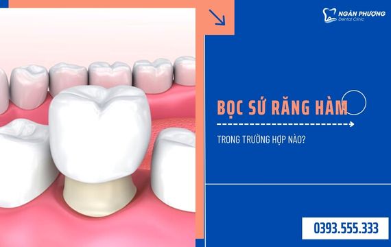 bọc sứ răng hàm trong trường hợp nào