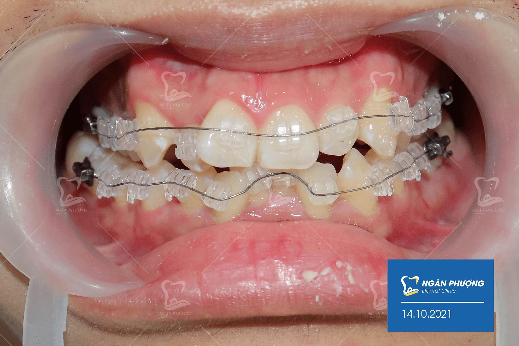 chỉnh nha khắc phục tình trạng răng khấp khểnh