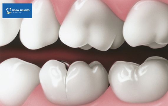 răng bị nứt vỡ