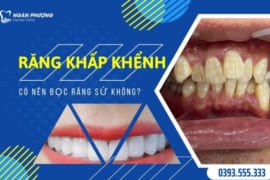 RĂNG KHẤP KHỂNH CÓ NÊN BỌC RĂNG SỨ KHÔNG?