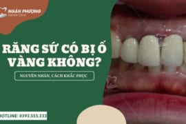 RĂNG SỨ CÓ BỊ Ố VÀNG KHÔNG? NGUYÊN NHÂN VÀ CÁCH KHẮC PHỤC
