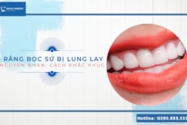 RĂNG BỌC SỨ BỊ LUNG LAY- NGUYÊN NHÂN, CÁCH KHẮC PHỤC