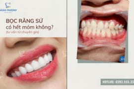 BỌC RĂNG SỨ CÓ HẾT MÓM KHÔNG? PHƯƠNG PHÁP NÀO TỐI ƯU DÀNH CHO RĂNG MÓM?