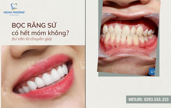 Chàng trai 9x sở hữu một gương mặt Hàn Quốc điển trai nhờ niềng răng móm 2  năm 3 tháng  nhakhoathuyanh