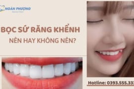 BỌC SỨ RĂNG KHỂNH – NÊN HAY KHÔNG NÊN?