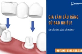 GIÁ LÀM CẦU RĂNG SỨ BAO NHIÊU? LÀM CẦU RĂNG SỨ CÓ ĐẮT KHÔNG?