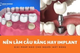 NÊN LÀM CẦU RĂNG HAY IMPLANT? GIẢI PHÁP NÀO CHO NGƯỜI MẤT RĂNG