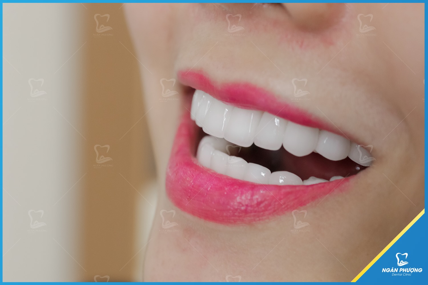 răng sứ cao cấp Nacera