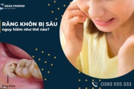 RĂNG KHÔN BỊ SÂU NGUY HIỂM NHƯ THẾ NÀO?- NÊN NHỔ HAY KHÔNG NHỔ?