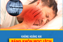 RĂNG KHÔN MỌC LỆCH NÊN XỬ LÝ NHƯ THẾ NÀO?