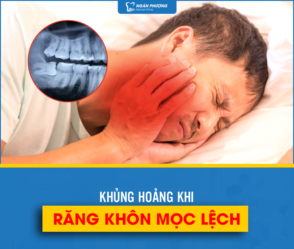 răng khôn mọc lệch nên xử lý như thế nào