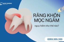 RĂNG KHÔN MỌC NGẦM NGUY HIỂM NHƯ THẾ NÀO?