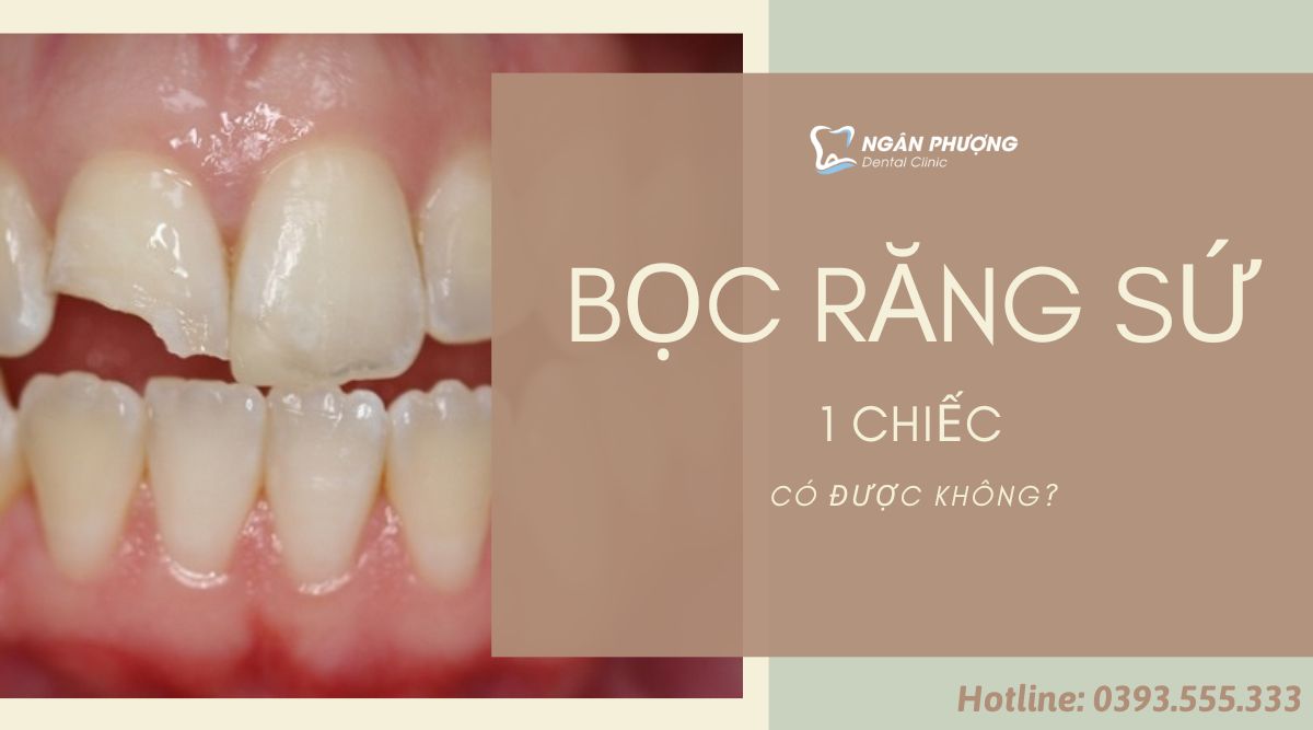 bọc răng sứ 1 chiếc có được không