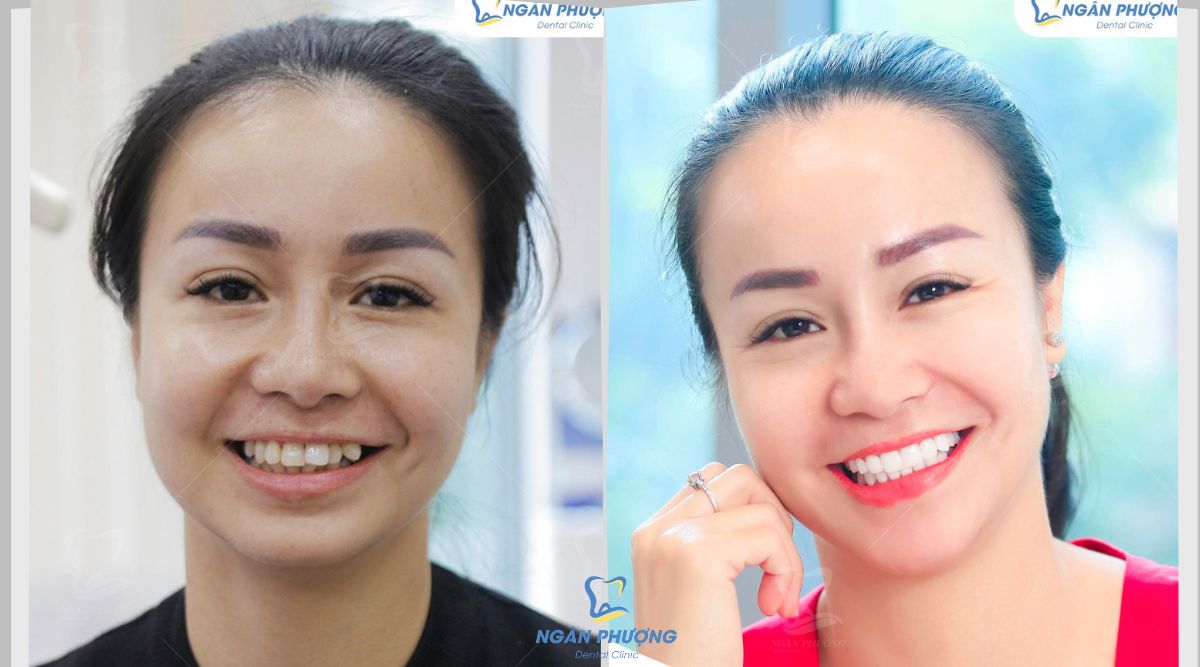 bọc răng sứ lệch lạc thay đổi khuôn mặt