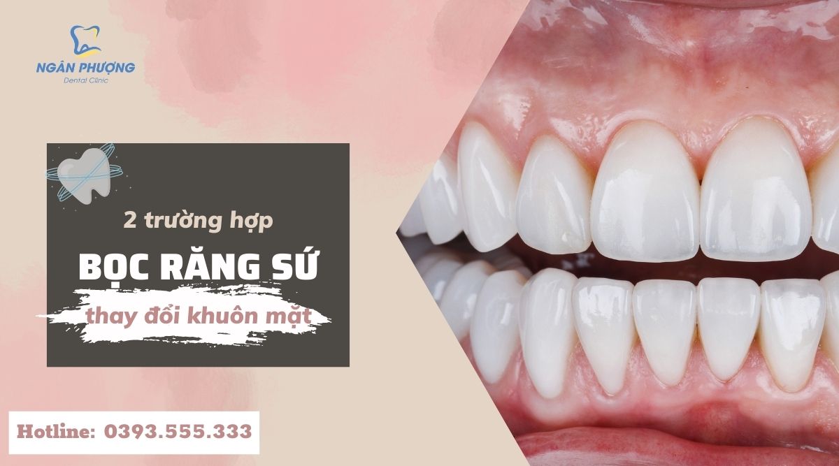 bọc răng sứ thay đổi khuôn mặt