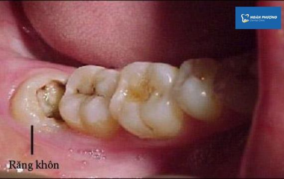 40 tuổi mọc răng khôn có nên nhổ không?