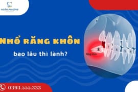 NHỔ RĂNG KHÔN BAO LÂU THÌ LÀNH?