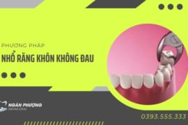 3 PHƯƠNG PHÁP NHỔ RĂNG KHÔN KHÔNG ĐAU HIỆN NAY