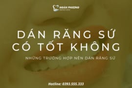 DÁN RĂNG SỨ CÓ TỐT KHÔNG? NHỮNG TRƯỜNG HỢP NÊN DÁN RĂNG SỨ
