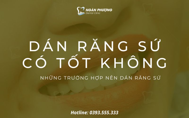dán răng sứ có tốt không