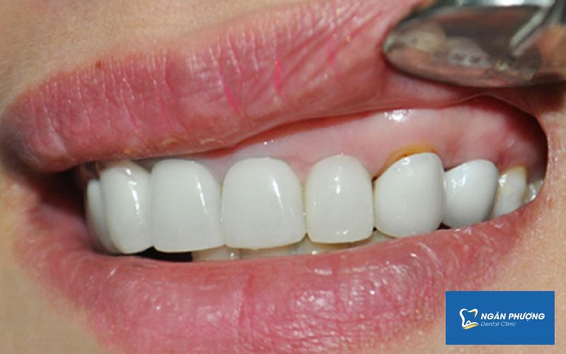 nhược điểm của phương pháp dán răng sứ không mài răng