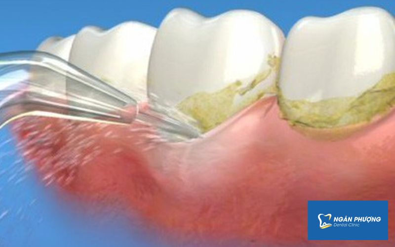 lấy cao răng định kỳ